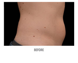 Coolsculpting Before and After | Dr. Thomas Hubbard