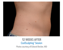 Coolsculpting Before and After | Dr. Thomas Hubbard