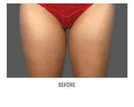 Coolsculpting Before and After | Dr. Thomas Hubbard