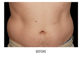 Coolsculpting Before and After | Dr. Thomas Hubbard