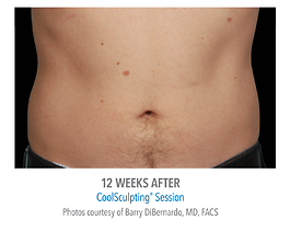 Coolsculpting Before and After | Dr. Thomas Hubbard