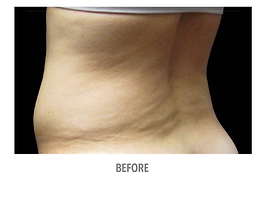 Coolsculpting Before and After | Dr. Thomas Hubbard