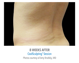 Coolsculpting Before and After | Dr. Thomas Hubbard