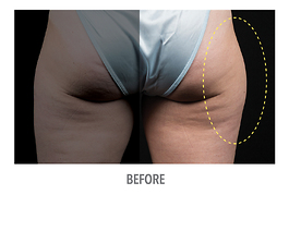 Coolsculpting Before and After | Dr. Thomas Hubbard