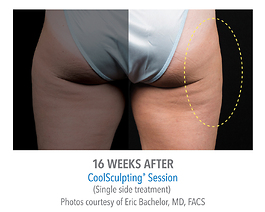 Coolsculpting Before and After | Dr. Thomas Hubbard