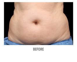 Coolsculpting Before and After | Dr. Thomas Hubbard