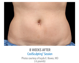 Coolsculpting Before and After | Dr. Thomas Hubbard