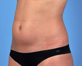 Coolsculpting Before and After | Dr. Thomas Hubbard