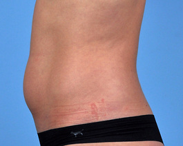 Coolsculpting Before and After | Dr. Thomas Hubbard