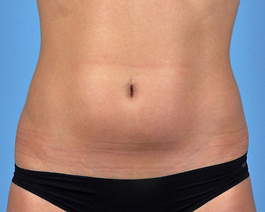 Coolsculpting Before and After | Dr. Thomas Hubbard