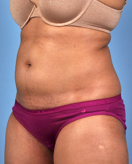 Coolsculpting Before and After | Dr. Thomas Hubbard