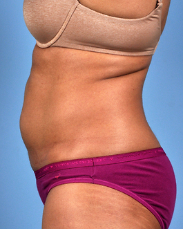 Coolsculpting Before and After | Dr. Thomas Hubbard