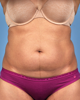 Coolsculpting Before and After | Dr. Thomas Hubbard