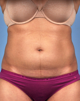 Coolsculpting Before and After | Dr. Thomas Hubbard