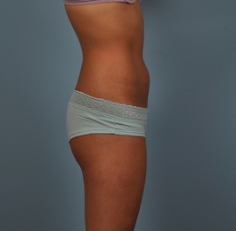 Coolsculpting Before and After | Dr. Thomas Hubbard