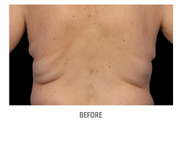 Coolsculpting Before and After | Dr. Thomas Hubbard