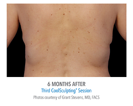 Coolsculpting Before and After | Dr. Thomas Hubbard