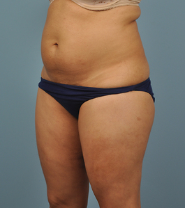 Coolsculpting Before and After | Dr. Thomas Hubbard