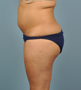 Coolsculpting Before and After | Dr. Thomas Hubbard