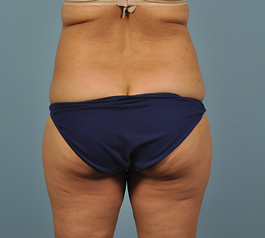 Coolsculpting Before and After | Dr. Thomas Hubbard