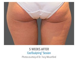 Coolsculpting Before and After | Dr. Thomas Hubbard