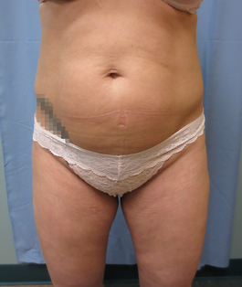 Coolsculpting Before and After | Dr. Thomas Hubbard