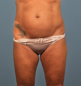 Coolsculpting Before and After | Dr. Thomas Hubbard