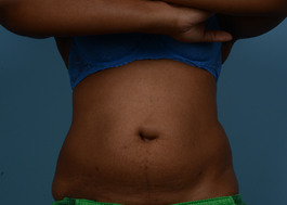 Coolsculpting Before and After | Dr. Thomas Hubbard