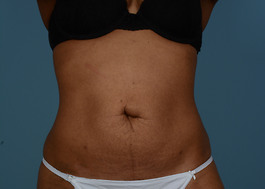 Coolsculpting Before and After | Dr. Thomas Hubbard