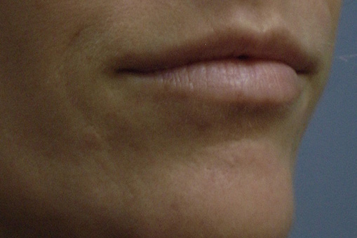 Injectable Fillers Before and After | Dr. Thomas Hubbard