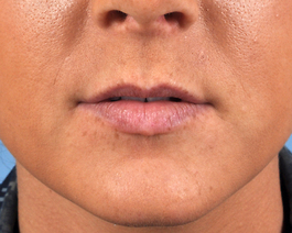 Lip Enhancement Before and After | Dr. Thomas Hubbard