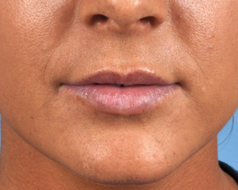 Lip Enhancement Before and After | Dr. Thomas Hubbard