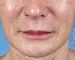 Lip Enhancement Before and After | Dr. Thomas Hubbard