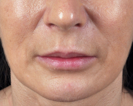 Lip Enhancement Before and After | Dr. Thomas Hubbard