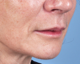 Lip Enhancement Before and After | Dr. Thomas Hubbard