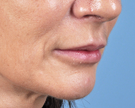 Lip Enhancement Before and After | Dr. Thomas Hubbard