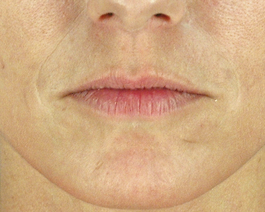 Lip Enhancement Before and After | Dr. Thomas Hubbard