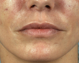 Lip Enhancement Before and After | Dr. Thomas Hubbard