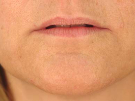 Lip Enhancement Before and After | Dr. Thomas Hubbard