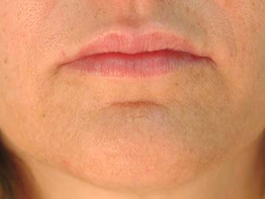 Lip Enhancement Before and After | Dr. Thomas Hubbard