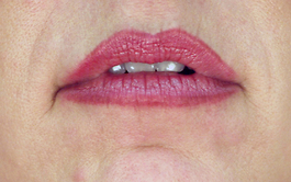 Lip Enhancement Before and After | Dr. Thomas Hubbard