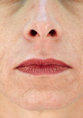 Lip Enhancement Before and After | Dr. Thomas Hubbard