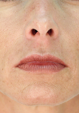 Lip Enhancement Before and After | Dr. Thomas Hubbard