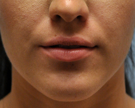 Lip Enhancement Before and After | Dr. Thomas Hubbard