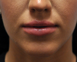 Lip Enhancement Before and After | Dr. Thomas Hubbard