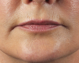 Lip Enhancement Before and After | Dr. Thomas Hubbard