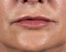 Lip Enhancement Before and After | Dr. Thomas Hubbard