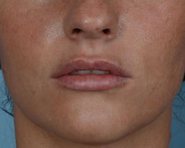 Lip Enhancement Before and After | Dr. Thomas Hubbard