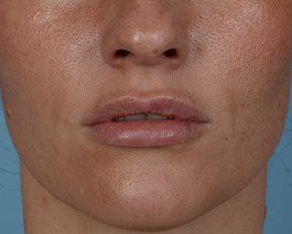 Lip Enhancement Before and After | Dr. Thomas Hubbard