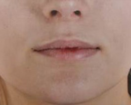 Lip Enhancement Before and After | Dr. Thomas Hubbard